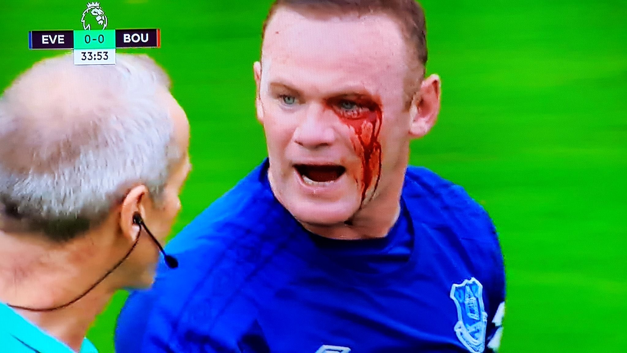 Pain Rooney Striker Suffers Horrific Eye Injury Besoccer
