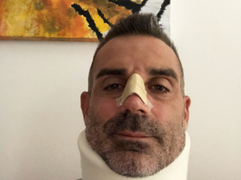 Sorrentino, avec une minerve et une bandage sur le nez. Twitter